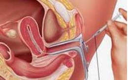 Chưa có con vẫn có thể bị vô sinh thứ phát